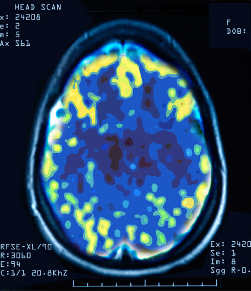 Cross section scan of healthy brain