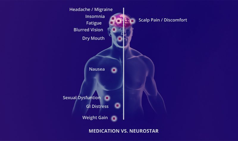 NeuroStar Does Not Have the Side Effects of Medication